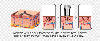 Do You Understand The Principle And Protection Of Laser Tattoo Removal?