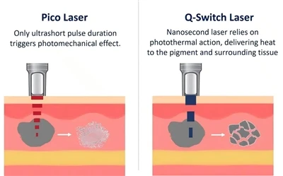 Safety Measures For Pico Laser Vs Q-Switch Laser