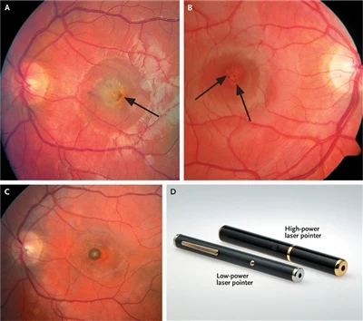 Symptoms And Protection Of Laser Eye Damage