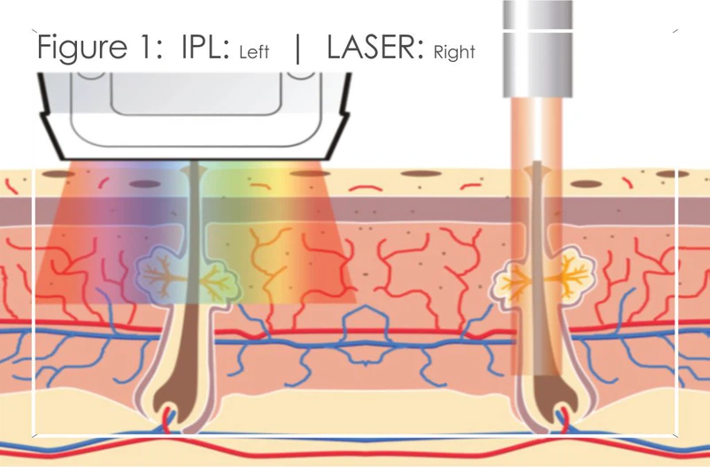 IPL LASER IPL LASER