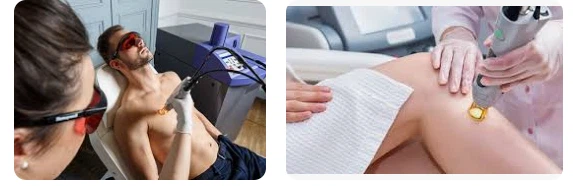 laser hair removal laser hair removal