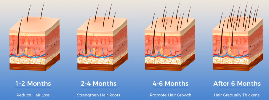 Laser in Hair Growth Devices Laser in Hair Growth Devices